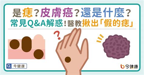 為甚麼會長痣|是痣？還是皮膚癌？皮膚科醫師教你揪出「假的痣」，。